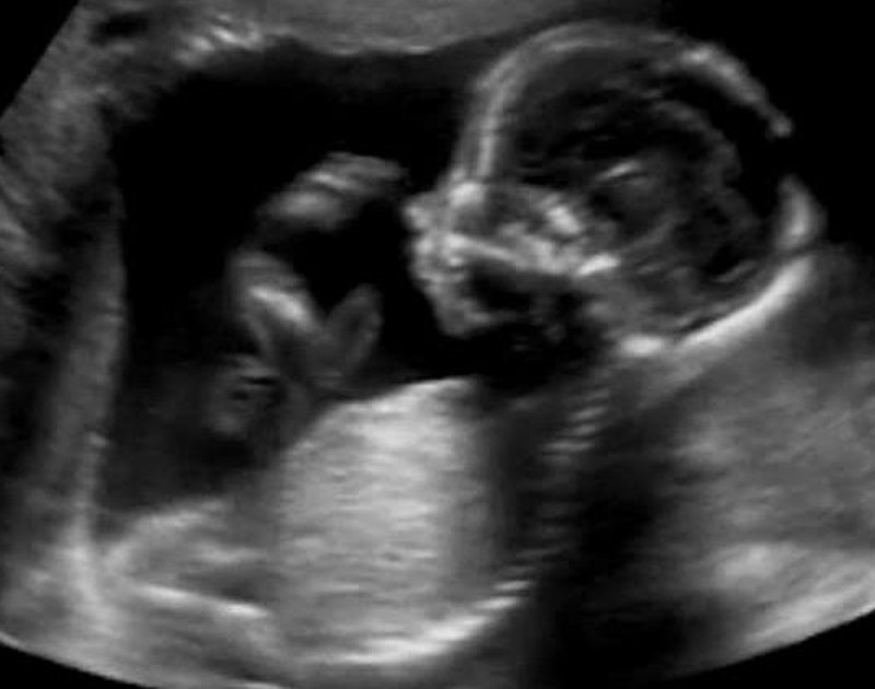 Texas asks court to allow dismemberment abortion ban until further ...