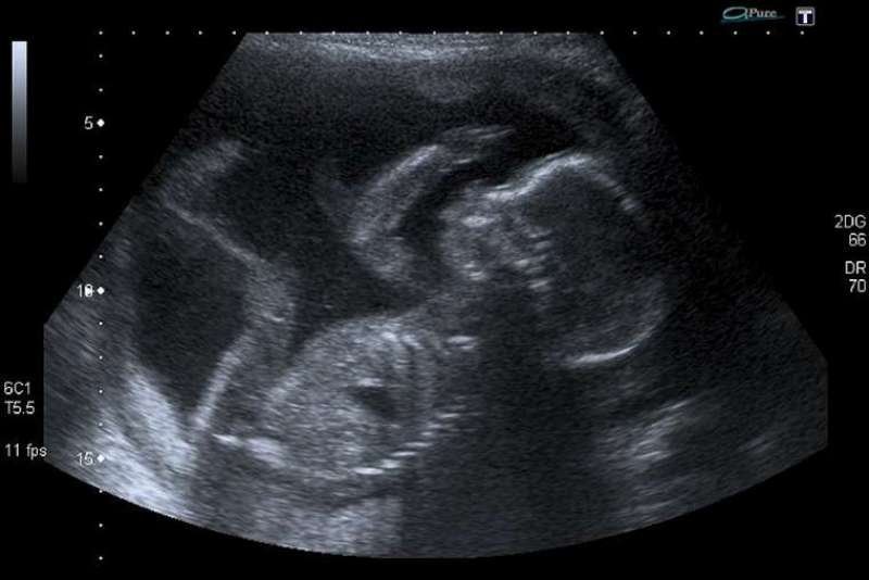An unborn baby at 20 weeks. Credit: Steve via Flickr (CC BY-NC 2.0).