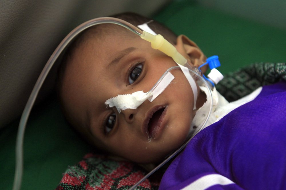 A malnourished child receives treatment at a medical center in Sanaa