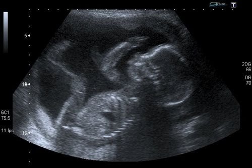 An unborn baby at 20 weeks -- well within the second trimester