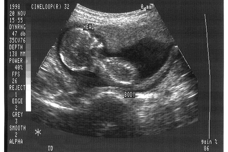Ultrasound. Credit: CDC/Jim Gathany