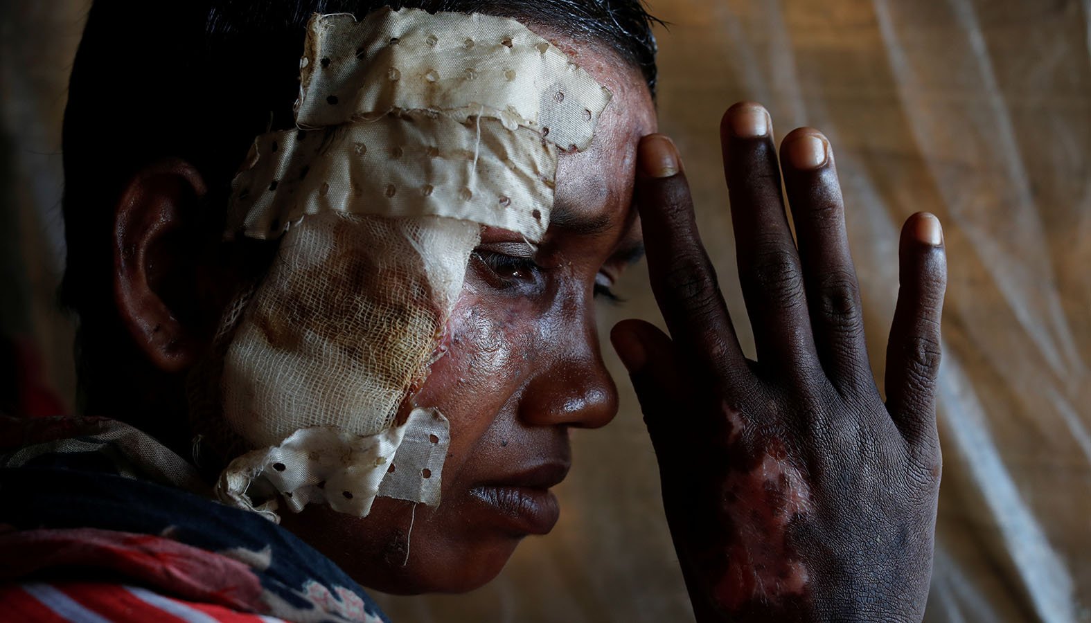 A Rohingya woman who says she was beaten and burned by soldiers in Myanmar poses for a photograph in 2017. Cardinal Charles Bo of Yangon, Myanmar, has appealed to the international community not to punish the people of Myanmar as the country faces genocide charges over the military's 2017 crackdown on Rohingya. (CNS photo/Jorge Silva, Reuters)