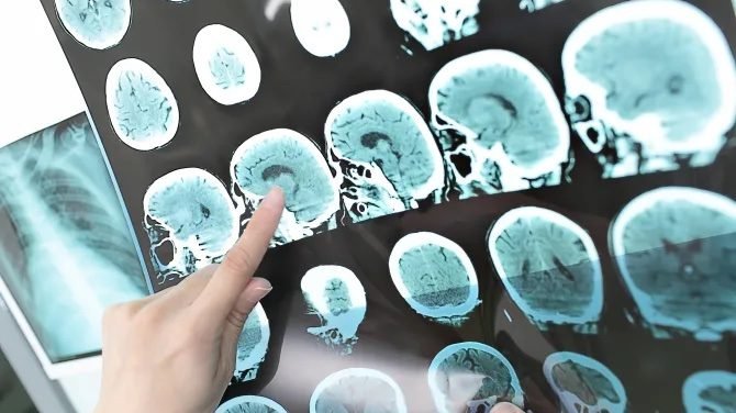 Brain Death