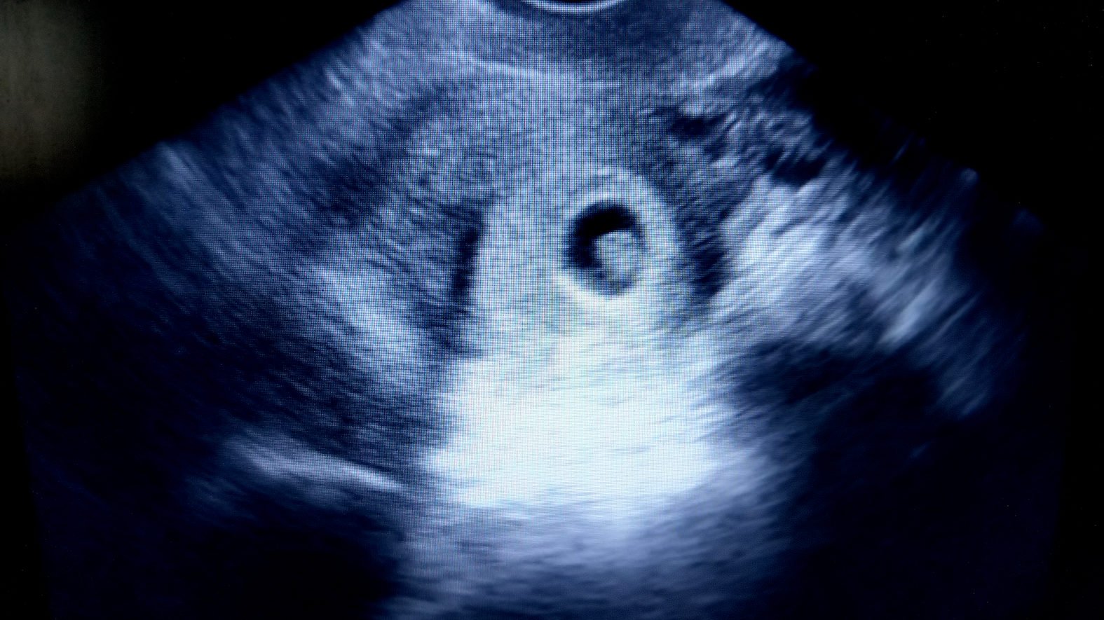 Abortion
