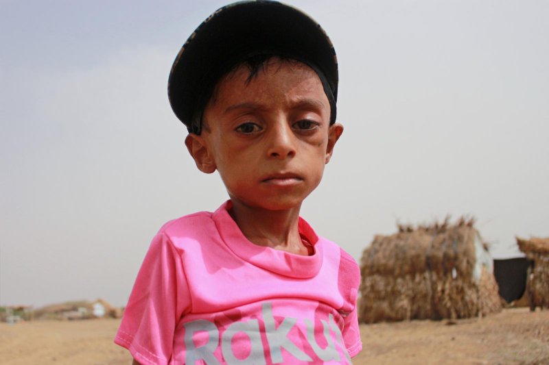 Un niño desnutrido posa para una foto en su pueblo de Abs, Yemen, el 17 de julio de 2020. Durante el Angelus del 1 de enero, el Papa Francisco ofreció oraciones por el pueblo del Yemen devastado por la guerra, especialmente por los niños de la nación que se quedaron sin educación y a menudo sin comida por años de guerra civil. (Foto CNS/Eissa Alragehi, Reuters)