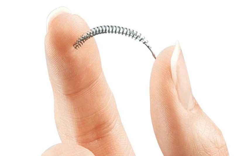 Essure coil (Credit_Conceptus Inc. via Wikipedia Fair Use/CNA)