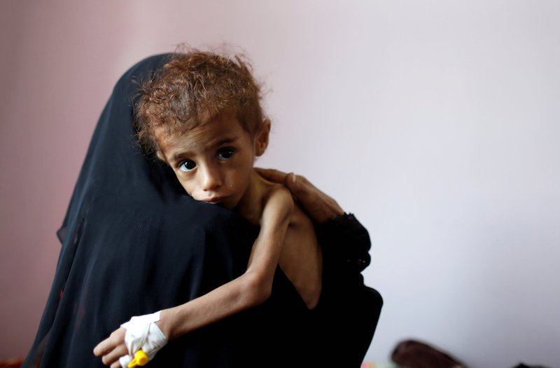 A woman holds a malnourished child Oct. 6 at a hospital in Sanaa