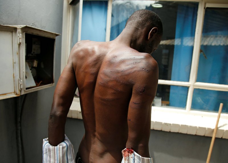 A man who was injured during violent protests is seen at a hospital in Harare