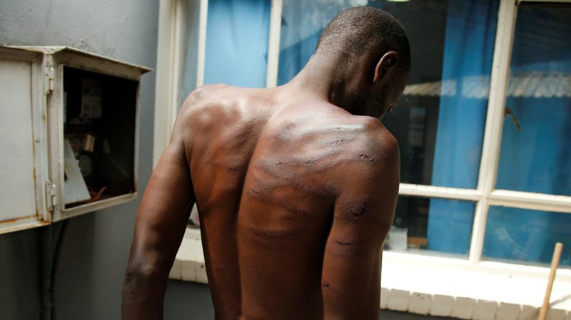 A man who was injured during violent protests is seen at a hospital in Harare, Zimbabwe, Jan. 16, 2019. The U.S. State Department has issued its annual "country reports" on human rights. (CNS photo/Philimon Bulawayo, Reuters)